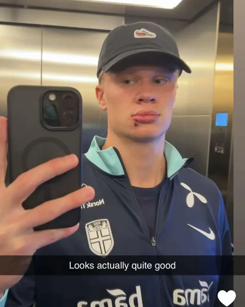 Ο Έρλινγκ Χάαλαντ μετά το ατύχημα / Πηγή: Snapchat (@erling.haaland)