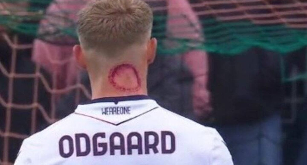 Σαν να τον δάγκωσε... ζόμπι! Μυστήριο γύρω από το κόκκινο σημάδι στον αυχένα του Όντγκααρντ (pic)