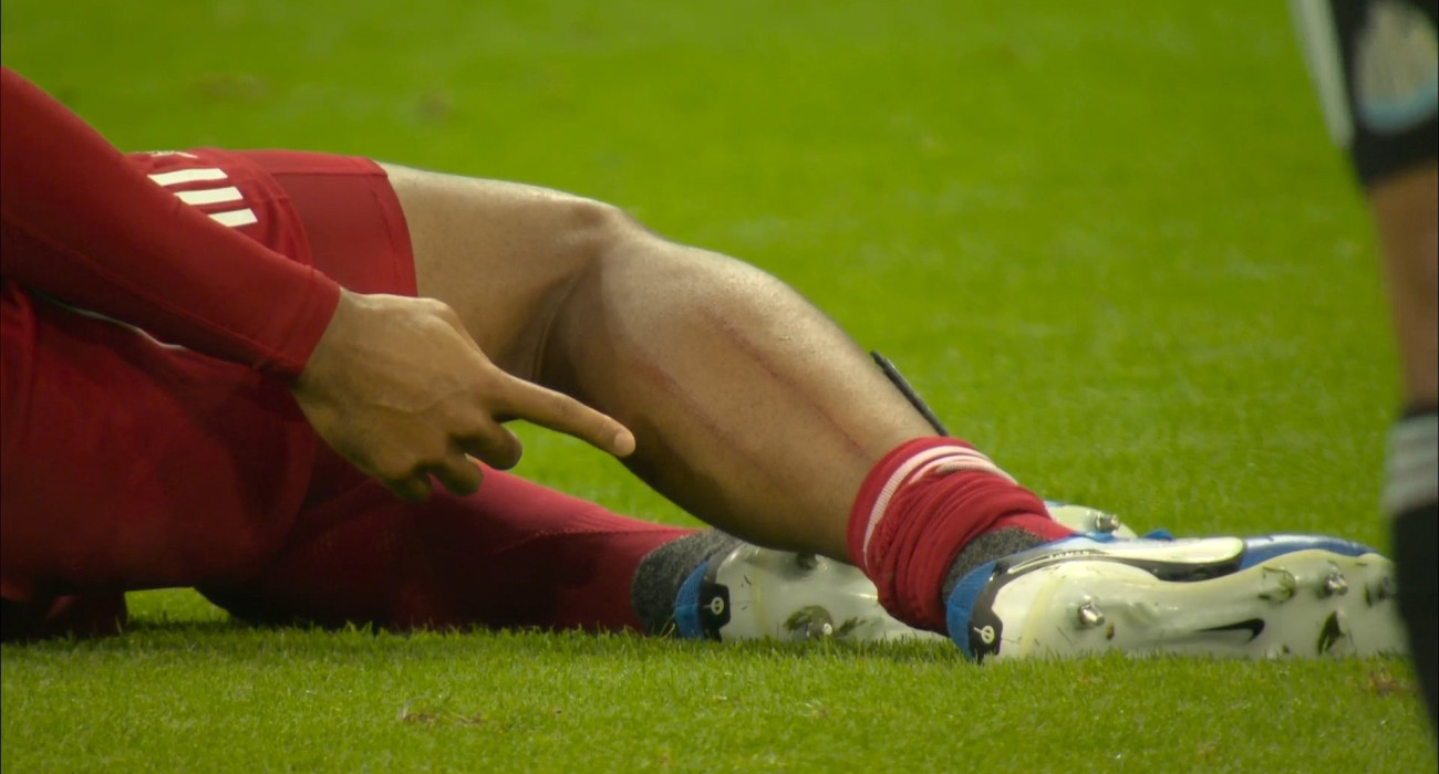 Το πόδι του Βίρτζιλ Φαν Ντάικ μετά το τάκλιν του Γκόρντον / Screenshot