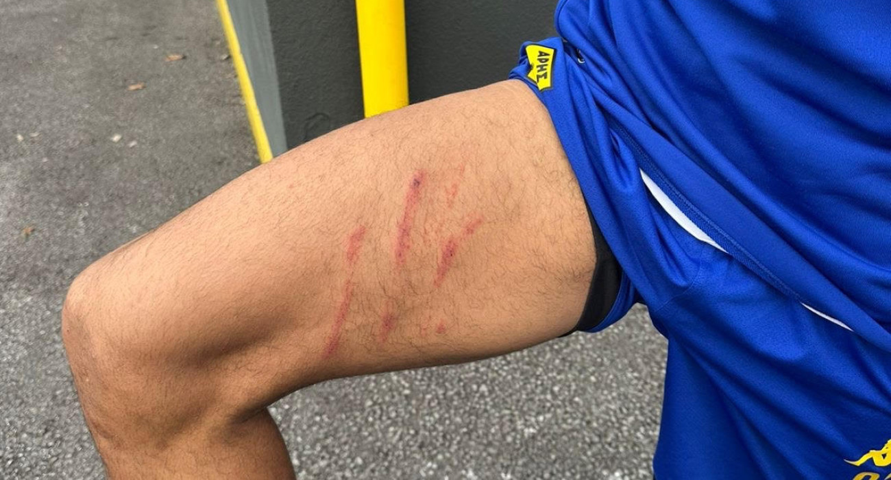 Το τραυματισμένο πόδι του Ρόουζ/Πηγή: arisfc