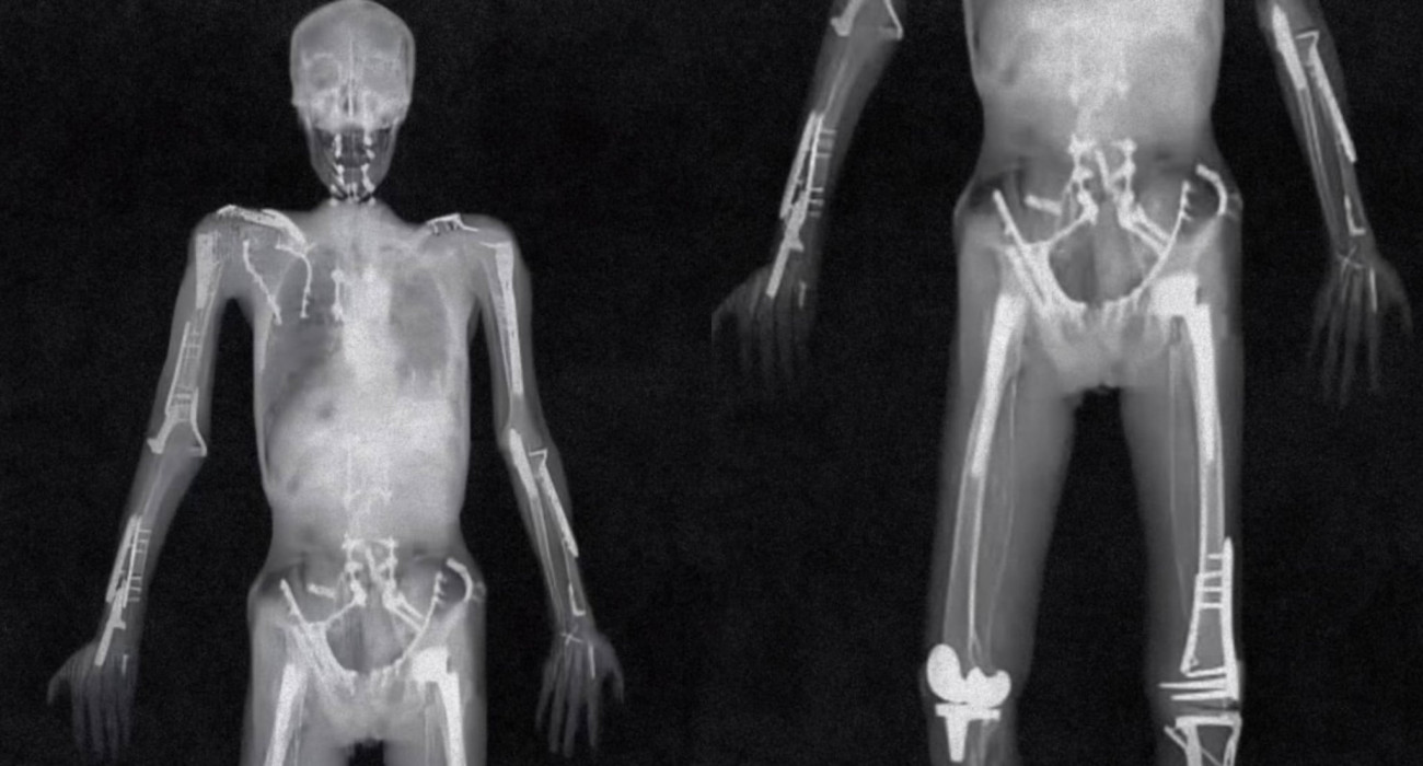 Αυτή είναι η θρυλική ακτινογραφία του Τράβις Παστράνα