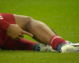 Το τρομακτικό σημάδι του Φαν Ντάικ στη γάμπα του μετά το «δολοφονικό» τάκλιν του Γκόρντον