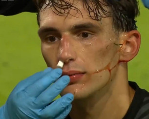 Η κατάθεση ψυχής του Μπότη: Δεν τον σταμάτησε ούτε το επικίνδυνο χτύπημα στο πρόσωπο (video)