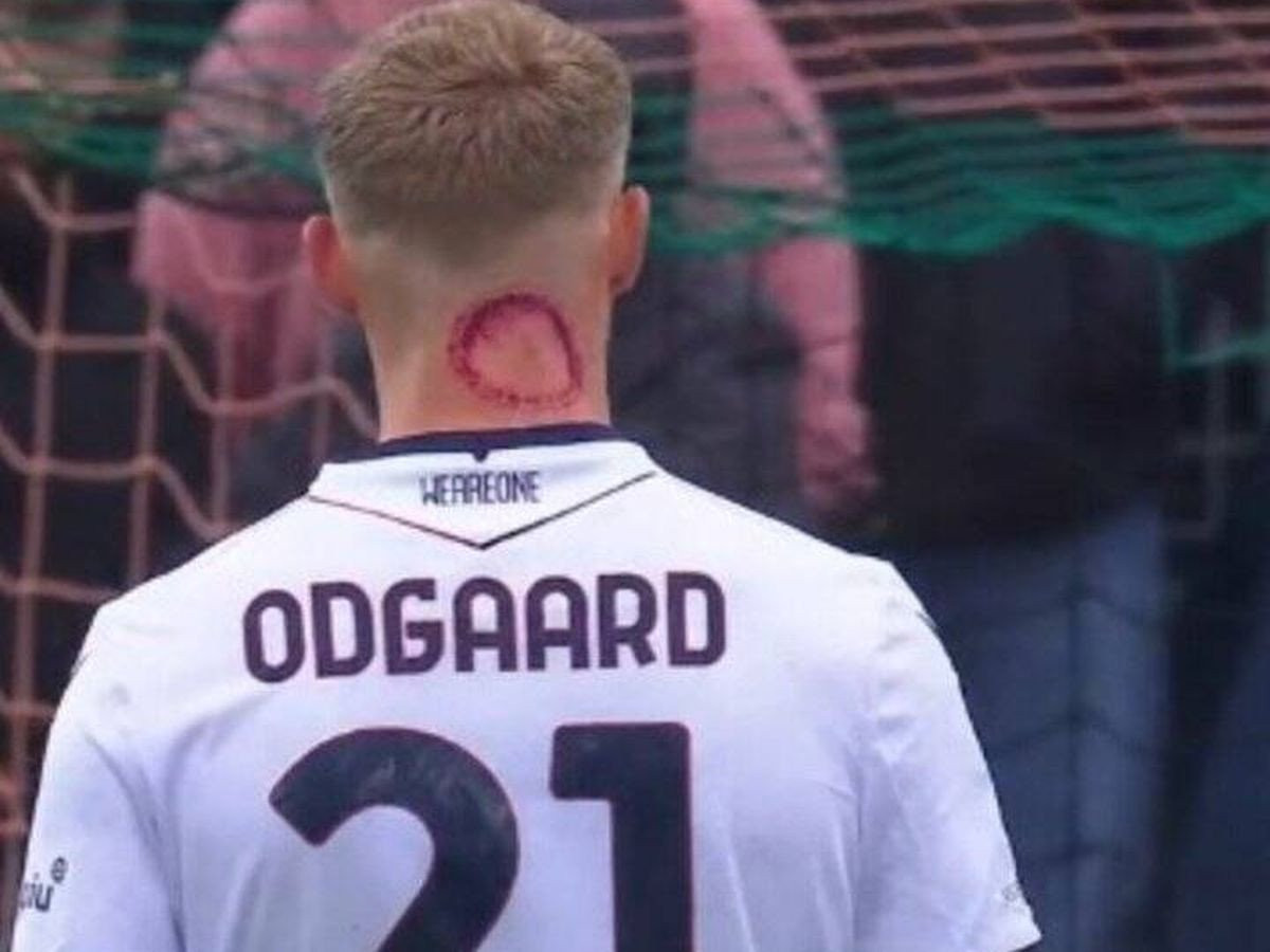 Σαν να τον δάγκωσε... ζόμπι! Μυστήριο γύρω από το κόκκινο σημάδι στον αυχένα του Όντγκααρντ (pic)