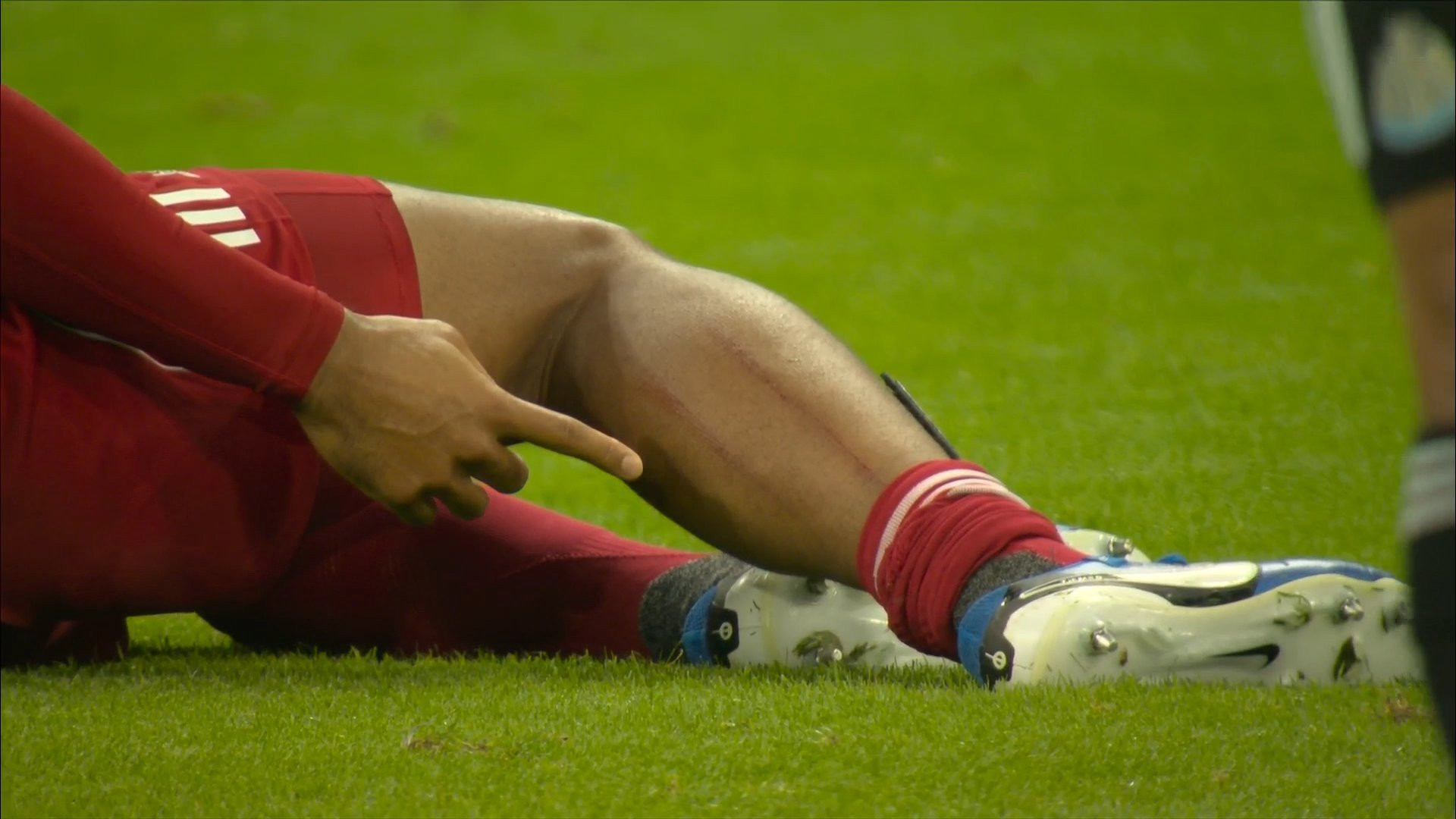 Το τρομακτικό σημάδι του Φαν Ντάικ στη γάμπα του μετά το «δολοφονικό» τάκλιν του Γκόρντον