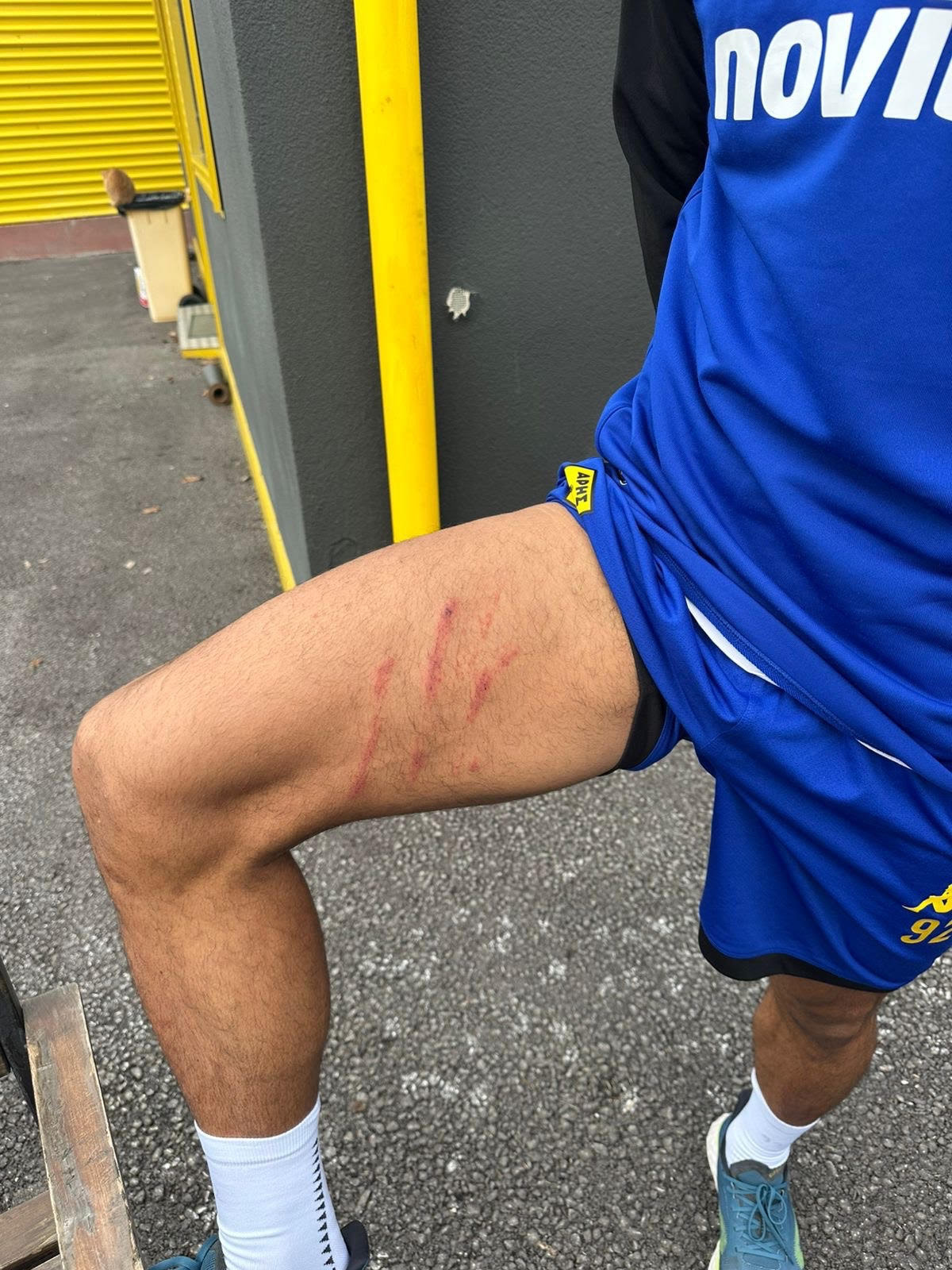 Ο Ρόουζ φωτογράφισε το πόδι του από τη «σκαριά» του Ιβανούσετς