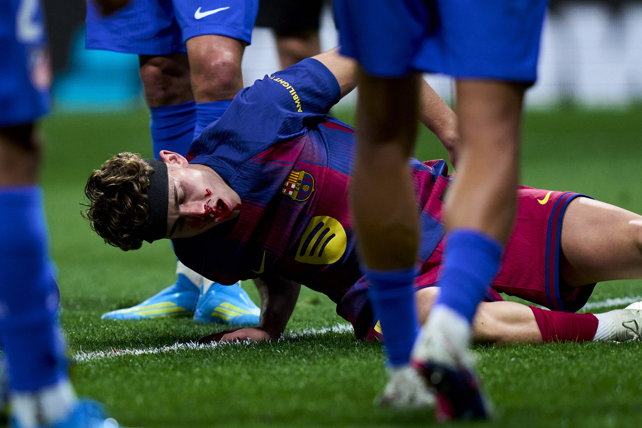 Τρομακτικός τραυματισμός του Φερμίν: Δέχθηκε χτύπημα στη μύτη και είχε ακατάσχετη αιμορραγία (video)